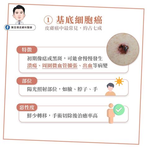 突然長痣|皮膚長痣、長斑是皮膚癌前兆？皮膚癌初期4大症狀快。